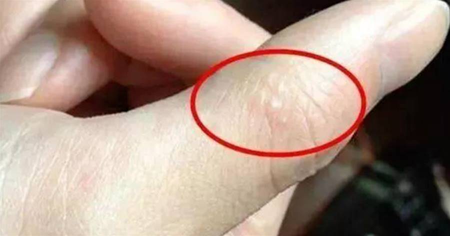 手上長這種透明小水泡,你以為是上火,其實是身體的求救信號!